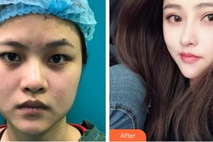 云南銅雀臺(tái)整形美容醫(yī)院丁蓓蓓整形價(jià)格表附切開雙眼皮案例展示