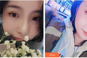 云南德普口腔醫(yī)院鄧艷整形價(jià)格表附牙齒隱形矯正案例展示