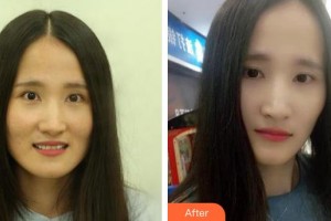 云南竹子口腔醫(yī)院萬碧濤整形價(jià)格表附牙齒陶瓷矯正案例展示