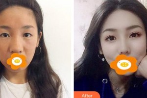 云南銅雀臺(tái)整形美容醫(yī)院周柯院長(zhǎng)整形價(jià)格表附鼻部綜合案例展示