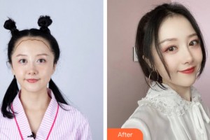 海南美媛醫(yī)學(xué)美容門(mén)診部杜洛鋒整形價(jià)格表附植發(fā)案例展示