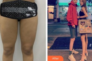 昆明吳氏嘉美美容醫(yī)院劉勤整形價(jià)格表附吸脂案例展示