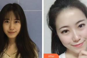 昆明吳氏嘉美美容醫(yī)院李韜整形價(jià)格表附無針?biāo)獍咐故?>
</a>
<h3 class=