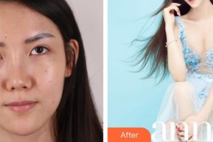 昆明都市儷人美容醫(yī)院金海坤整形價(jià)格表附墊鼻基底案例展示