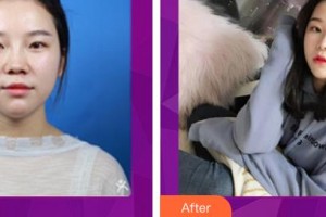 昆明夢想醫(yī)療美容醫(yī)院胡凱整形價(jià)格表附耳軟骨復(fù)合隆鼻案例展示