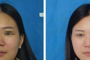 昆明醫(yī)學(xué)院整形美容中心焦圓華整形價(jià)格表附激光祛斑案例展示