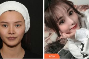 昆明都市儷人美容醫(yī)院楊麗璇整形價格表附鼻修復案例展示