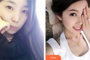 昆明麗都醫(yī)療美容醫(yī)院李榮整形價(jià)格表附牙齒隱形矯正案例展示