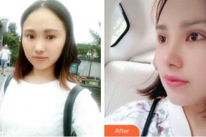 昆明天倫婦產(chǎn)醫(yī)院醫(yī)學(xué)整形美容中心李松虎整形價(jià)格表附鼻部綜合案例展示