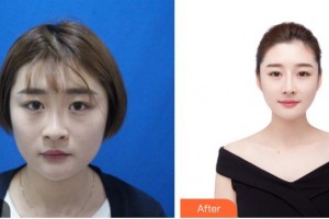 昆明赫柏醫(yī)療美容門診部于建濤整形價(jià)格表附鼻部綜合案例展示