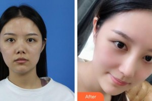 昆明天倫婦產(chǎn)醫(yī)院醫(yī)學整形美容中心蘭娜整形價格表附微針美膚案例展示