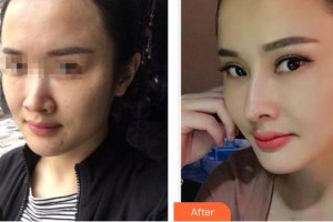 昆明維多利亞醫(yī)療美容醫(yī)院徐根艷整形價格表附去痘印痘坑案例展示