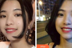 昆明前衛(wèi)美眼整形專科診所劉流整形價格表附牙齒隱形矯正案例展示