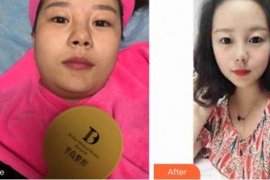 昆明維多利亞醫(yī)療美容醫(yī)院茶文麗整形價格表附微針水光案例展示