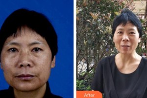 昆明市延安醫(yī)院杰西艾美容醫(yī)院謝國華整形價格表附微針美膚案例展示