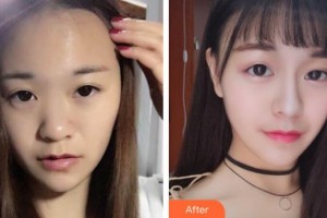 整形醫(yī)院陳茂年整形價格表附耳軟骨復合隆鼻案例展示