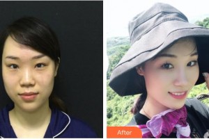 整形醫(yī)院周岳汗整形價格表附鼻部綜合案例展示