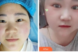 昆明赫柏醫(yī)療美容門診部金東杰整形價格表附開內眼角案例展示