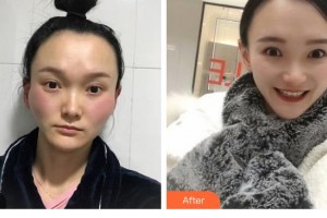 昆明維多利亞醫(yī)療美容醫(yī)院金浩彬整形價格表附顴骨顴弓整形術案例展示