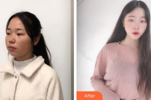 昆明市延安醫(yī)院杰西艾美容醫(yī)院王洋洋整形價格表附面部吸脂案例展示