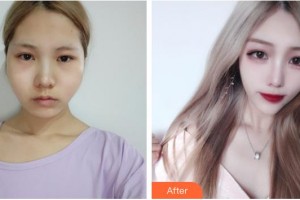 昆明卓星美容醫(yī)院牛軍州整形價(jià)格表附顴骨降低案例展示