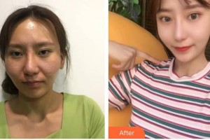 昆明國瑞整形美容醫(yī)院金昌義整形價格表附鼻部綜合案例展示