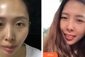 昆明市延安醫(yī)院杰西艾美容醫(yī)院付香蓮整形價(jià)格表附激光祛斑案例展示