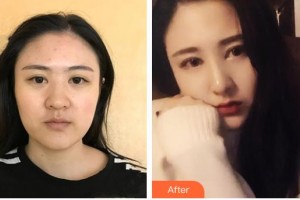 昆明夢想醫(yī)療美容醫(yī)院李華整形價格表附耳軟骨復合隆鼻案例展示