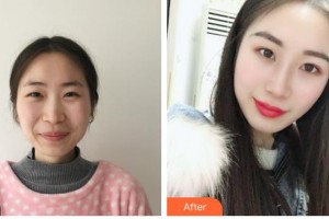 昆明薇莎整形美容醫(yī)院鄧麗麗整形價格表附鼻部綜合案例展示