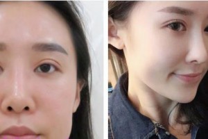 昆明薇莎整形美容醫(yī)院樸炫中整形價(jià)格表附假體隆鼻案例展示