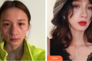 昆明薇莎整形美容醫(yī)院任德浩整形價格表附鼻部綜合案例展示