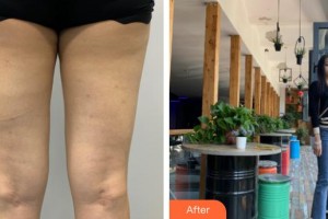 昆明愛(ài)萊美醫(yī)療美容醫(yī)院曾垂紳整形價(jià)格表附吸脂案例展示