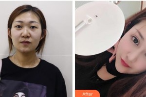 昆明夢(mèng)想醫(yī)療美容醫(yī)院李成龍整形價(jià)格表附切開(kāi)雙眼皮案例展示