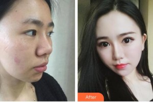 昆明韓辰整形醫(yī)院尹東方整形價(jià)格表附切開雙眼皮案例展示