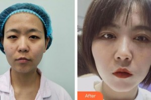 昆明前衛(wèi)美眼整形?？圃\所夏玲整形價(jià)格表附眼部綜合案例展示