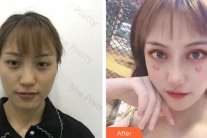 昆明前衛(wèi)美眼整形?？圃\所吳瓊整形價(jià)格表附切開雙眼皮案例展示