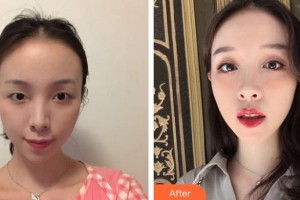 昆明韓辰整形醫(yī)院王陽(yáng)整形價(jià)格表附眼部綜合案例展示