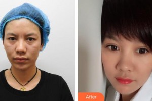 昆明璀璨人生醫(yī)療美容診所李鴻軍整形價(jià)格表附切開(kāi)雙眼皮案例展示