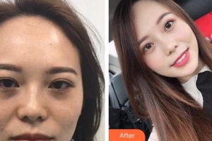 昆明夢(mèng)想醫(yī)療美容醫(yī)院張燕雄整形價(jià)格表附激光去黑眼圈案例展示