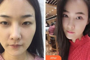 昆明璀璨人生醫(yī)療美容診所時(shí)保義整形價(jià)格表附開(kāi)外眼角案例展示