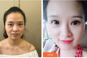 昆明璽蘭醫(yī)療美容診所趙建凱整形價(jià)格表附眼部案例展示