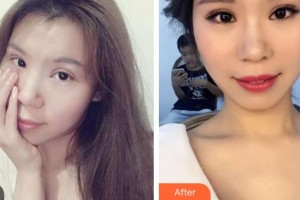 昆明璀璨人生醫(yī)療美容診所李德平整形價(jià)格表附皮切開(kāi)雙眼皮案例展示