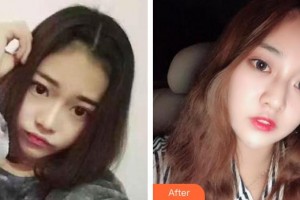 昆明夢(mèng)想醫(yī)療美容醫(yī)院史小英整形價(jià)格表附埋線雙眼皮案例展示