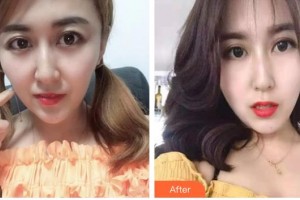 昆明卓星美容醫(yī)院劉廷整形價(jià)格表附埋線雙眼皮案例展示