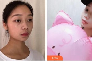 昆明華山眼科醫(yī)院何雨檀整形價(jià)格表附水氧活膚案例展示