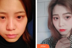 清遠(yuǎn)康華醫(yī)院整形美容中心（原清遠(yuǎn)武警醫(yī)院整形美容中心）徐昆明住院醫(yī)師整形價(jià)格表附激光祛斑案例展示