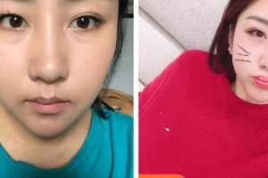 昆明華山眼科醫(yī)院王琨整形價(jià)格表附切開雙眼皮案例展示