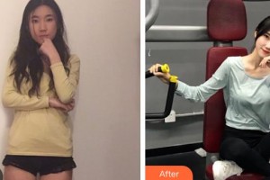 昆明海峽整形美容醫(yī)院趙根云整形價(jià)格表附玻尿酸精華導(dǎo)入案例展示