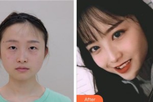 昆明醫(yī)科大學(xué)第二附屬醫(yī)院整形外科肖敏勤整形價(jià)格表附切開雙眼皮案例展示