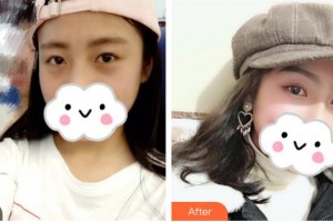 昆明醫(yī)科大學(xué)第二附屬醫(yī)院整形外科戴榮琴整形價(jià)格表附眼部綜合案例展示